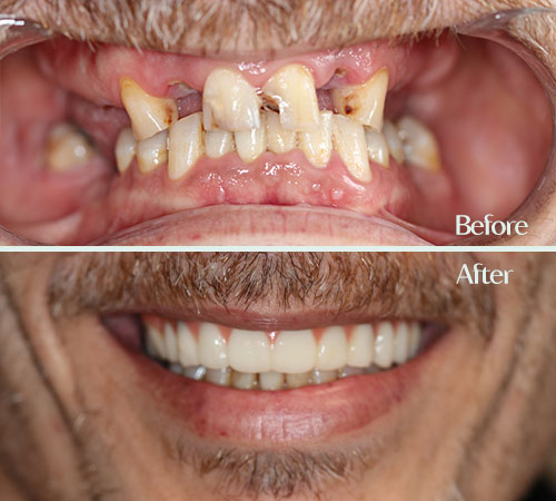 All on 4 dental imaplnts - Before After JJ Smile