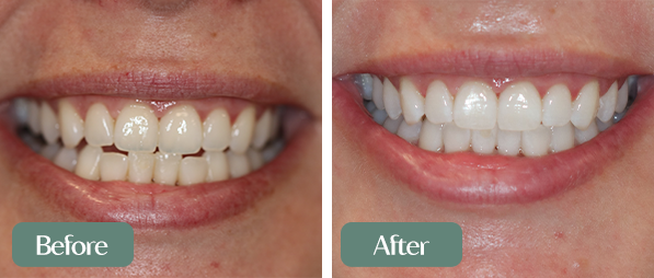 1 Teeth Whitening beforea nd after