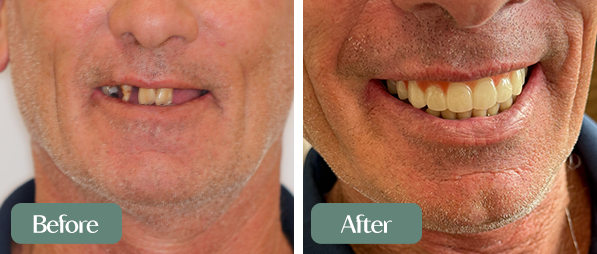 2 All on 4 +before and after