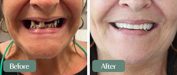 Denture Before and After 01