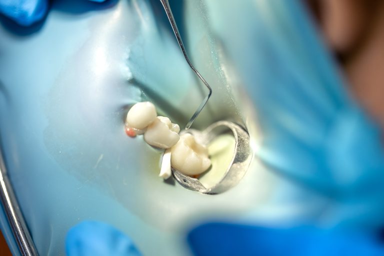 How Long Does a Root Canal Take and What to Expect