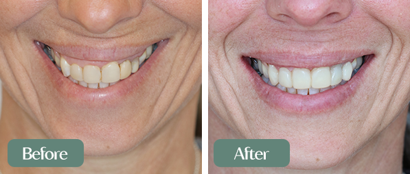 Veeners Implants _01