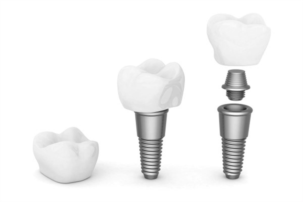 Loose Dental Implant Crown Symptoms & Fixes Guide