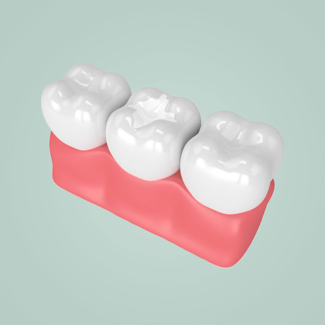 Tooth-Coloured Dental Fillings - JJ smiles dental gold coast
