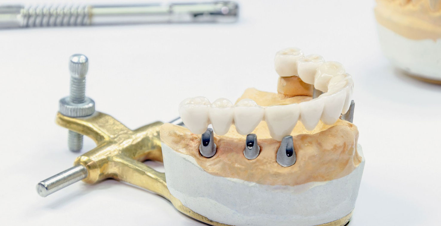 Who Is a Good Candidate for Dental Implants