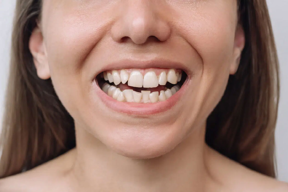 Can Veneers Straighten Crooked Teeth