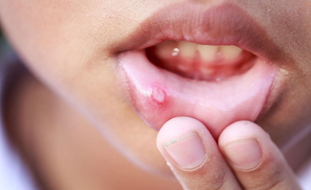 White Spots in the Mouth Causes, Symptoms and Treatment